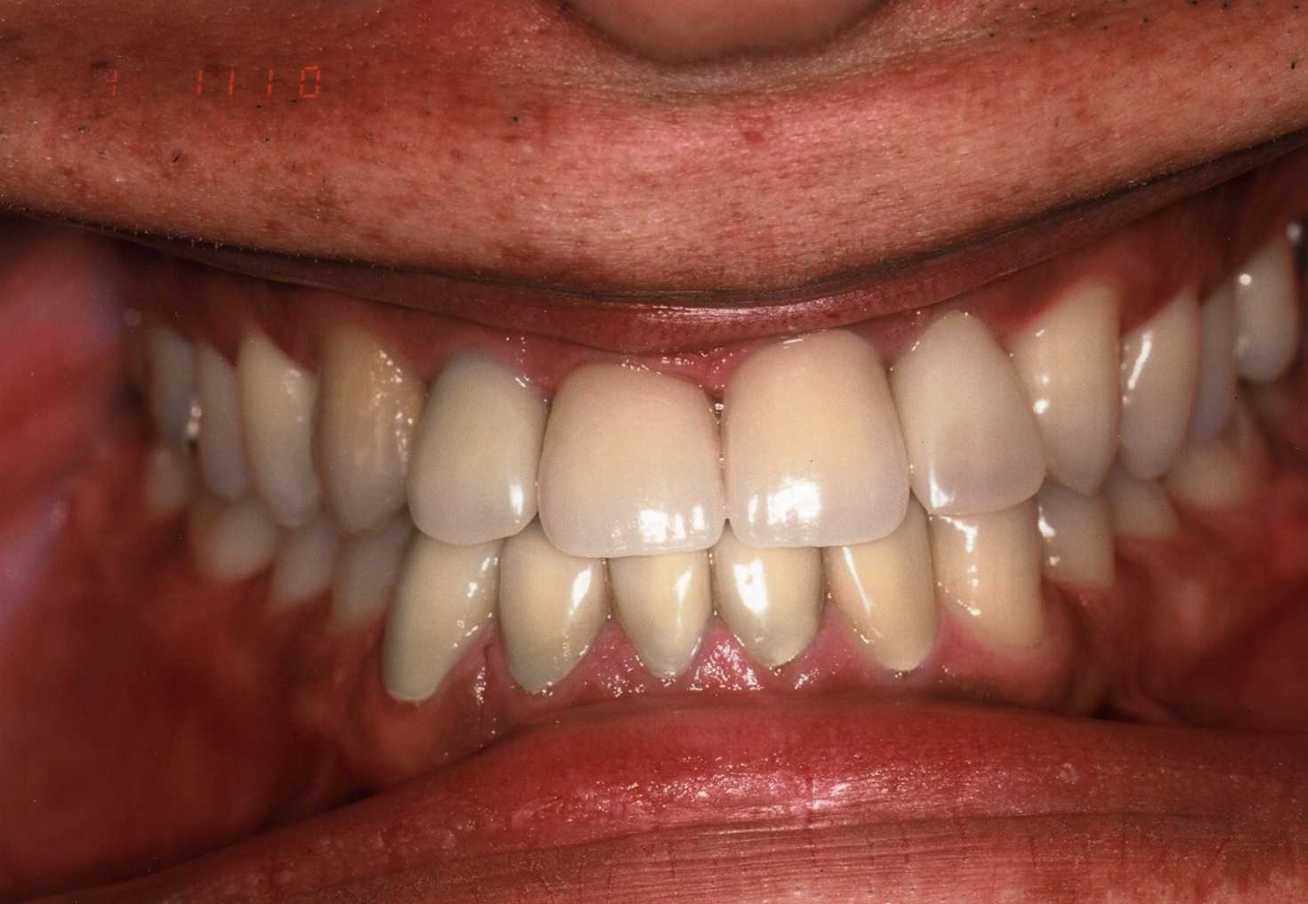 審美歯科治療