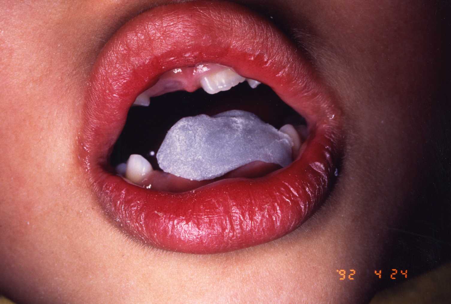 予防矯正